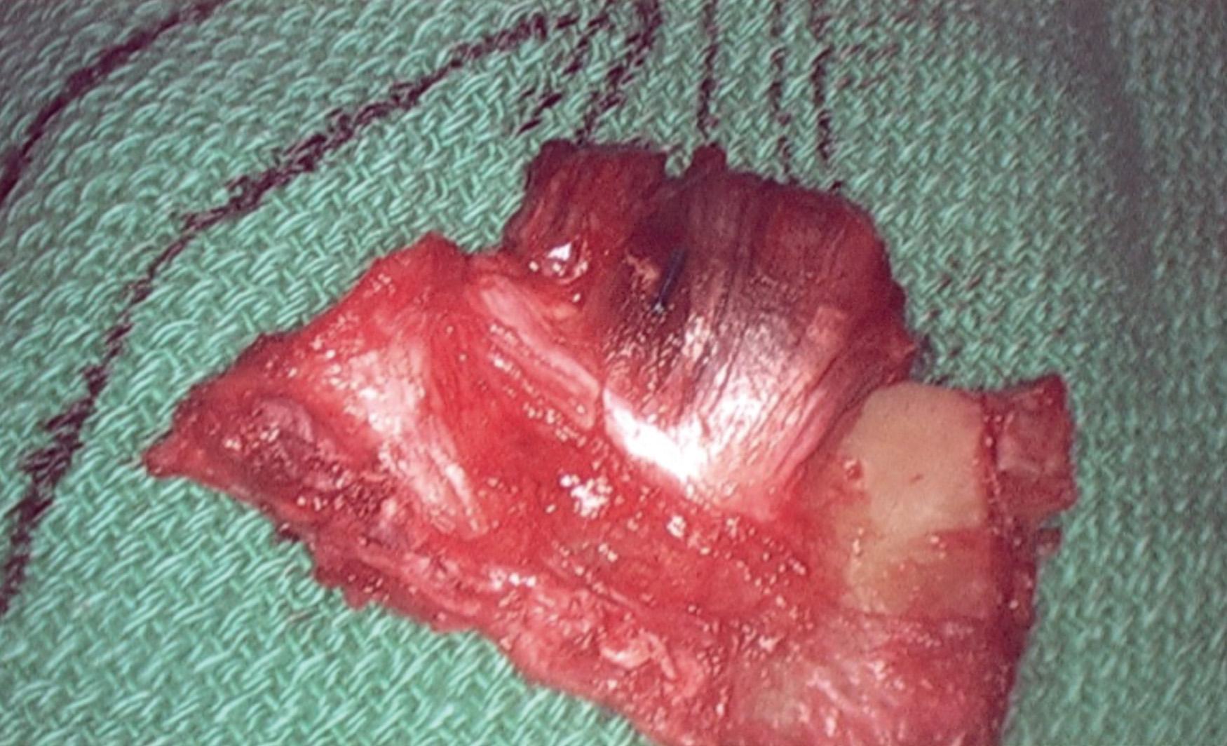 Fig. 24.11, Surgical specimen of the first rib with associated anterior scalene tendinous attachment.