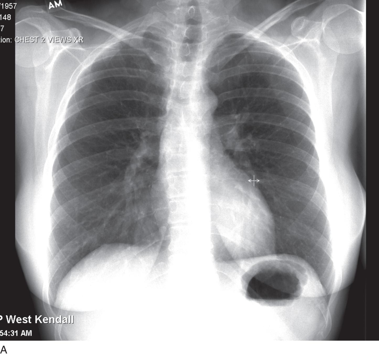 Fig. 24.2, A frontal chest radiograph (A) and magnified view (B) depict the presence of a right-sided cervical rib (arrow). This is just one of the possible causes of anatomic compression of the axillosubclavian vein.