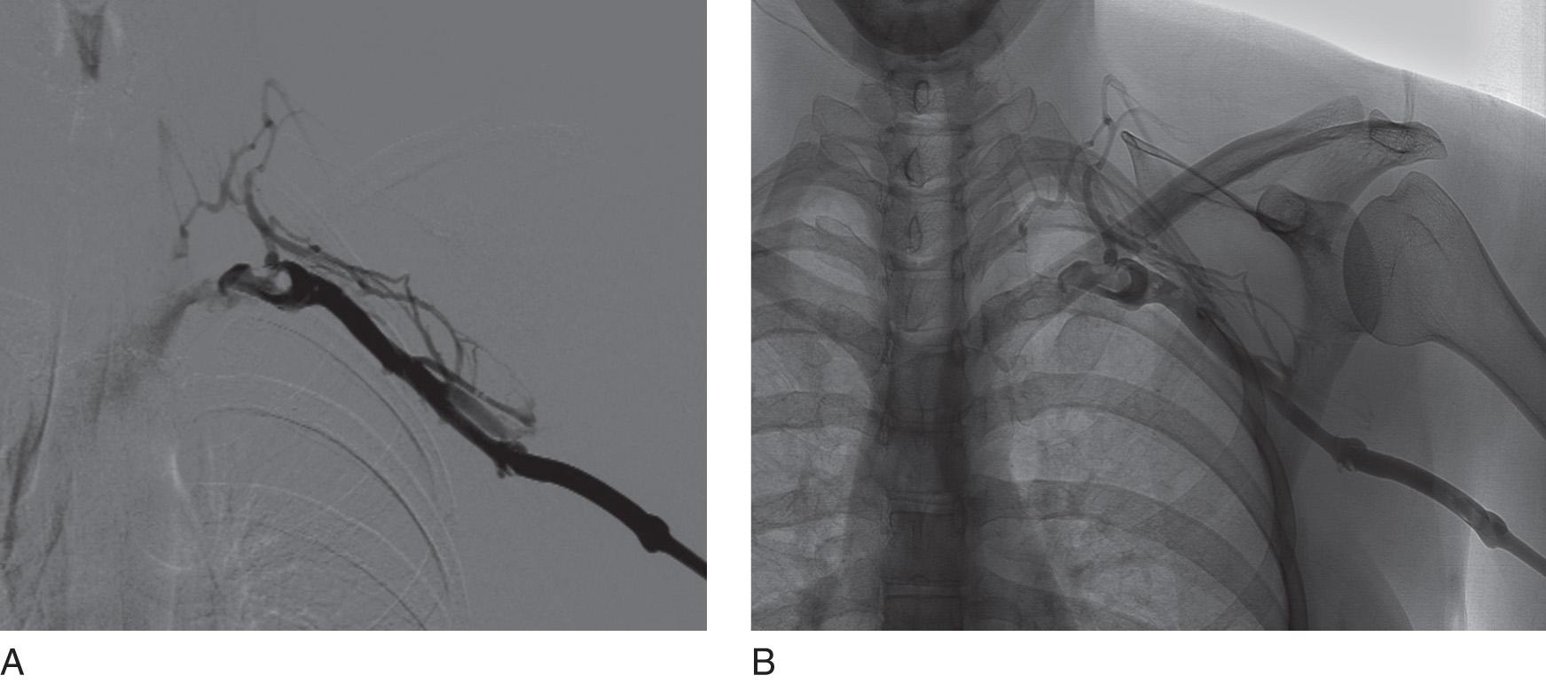 Fig. 24.4, A frontal left upper extremity venogram demonstrating occlusion with thrombosis of the left axillosubclavian vein in a subtracted (A) and unsubtracted (B) image.