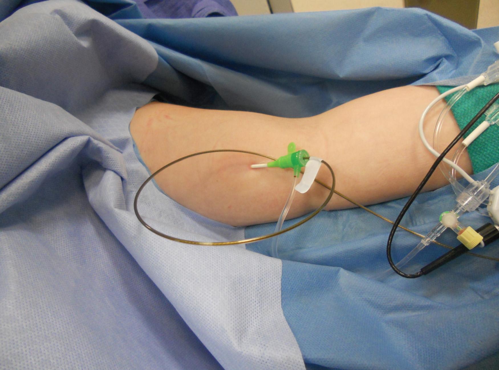 Fig. 24.6, Image demonstrating a 6-Fr sheath in the brachial vein with an EKOS infusion catheter through the sheath. This patient received 0.5 mg per hour of r-tPA (alteplase; Genentech, San Francisco, CA) infused via the EKOS catheter and 300 units per hour of heparin via the sheath.