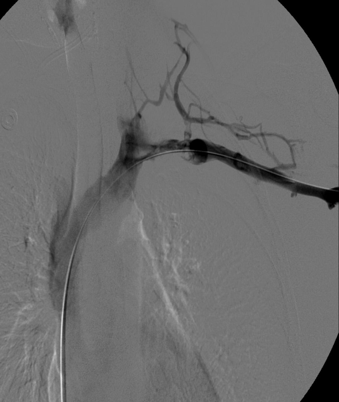 Fig. 24.7, Venogram after overnight thrombolysis demonstrating clearing of thrombus with minimal irregularity at the level of compression.