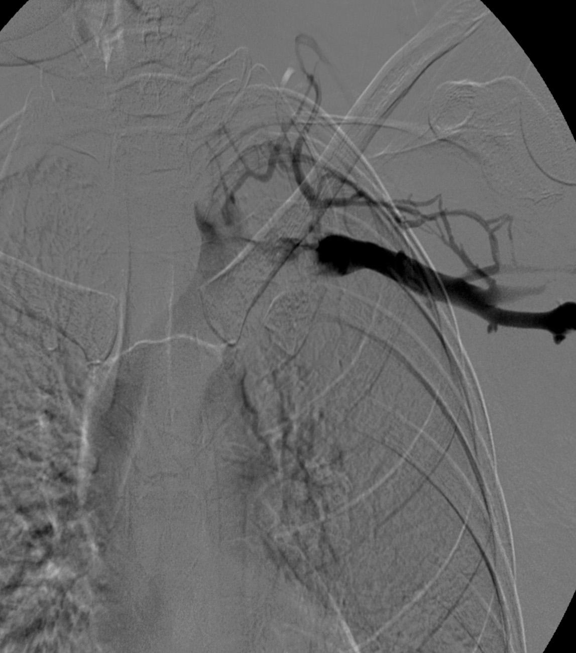 Fig. 24.8, Venogram performed with the patient in a stressed position.