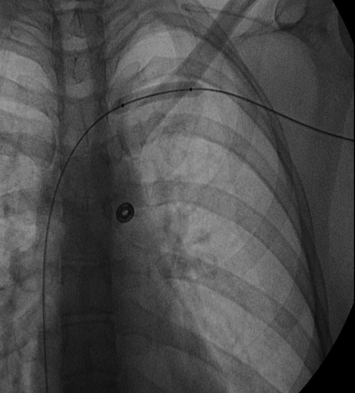 Fig. 24.10, Dilating the residual narrowing or venous thickening after lysis.