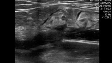 FIGURE 37.4, Position of the radiofrequency catheter ClosureFast™ 1.5 cm distal to the saphenofemoral junction.