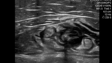 FIGURE 37.5, Ultrasound-guided tumescent anesthesia infiltration around the great saphenous vein.