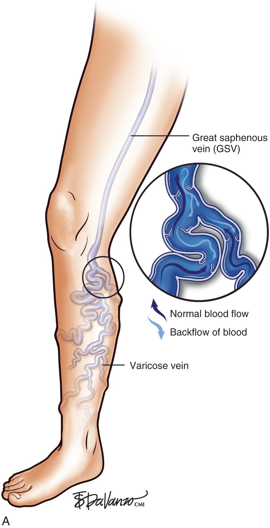 Fig. 5.1, (B) Typical varicose veins of the calf resulting from great saphenous vein incompetence.