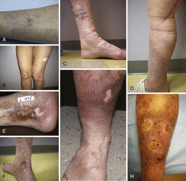 Figure 60-1, The classification of venous disease using CEAP system. A , Stage C1: Telangiectasia and reticular veins. B , Stage C2: Varicosities. C , Stage C3: Edema. Stage C4: Skin changes, including eczema and pigmentation ( D ) or lipodermatosclerosis and atrophie blanche ( E ). Stage C5: Preulcerative ( F ) or healed ( G ) ulcer. H , Stage C6: Active ulceration.