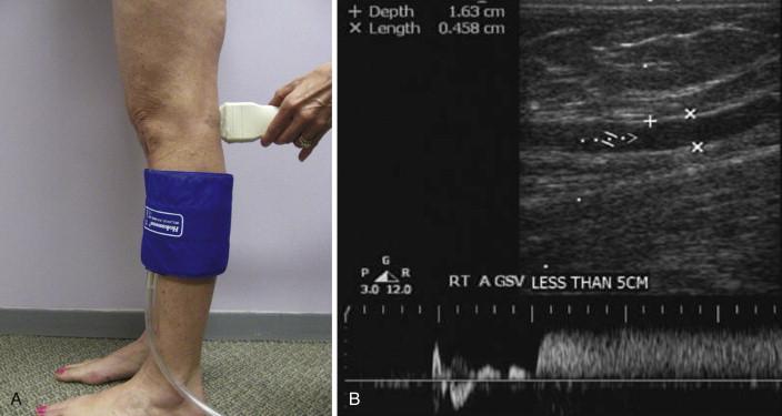 Figure 60-2, Duplex ultrasound examination of venous reflux. A , Patient is in the standing position, and reflux is induced with rapid cuff inflation. B , Flow is measured proximally over the veins using Doppler waveform analysis. After cuff deflation, reversal of flow for more than 0.5 seconds is consistent with reflux within the vein segment.