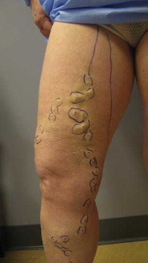 Figure 60-3, Preoperative marking of the varicose veins. Before the endovenous thermal ablation, the refluxing vein segments should be carefully mapped by ultrasound and marked percutaneously. Diameters, depths, aneurysmal segments, and partially occluded or tortuous segments should be indicated, as well as communication with tributaries or perforating veins. This information is used to plan the treatment of each segment of the target vein to use the minimal effective amount of energy and decrease the risk of complication.