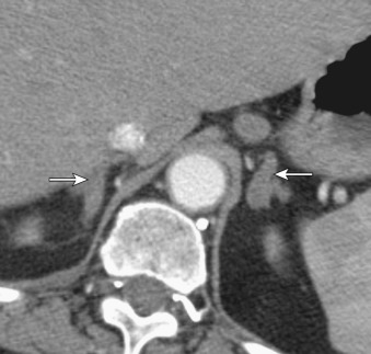 Figure 70-2, Axial computed tomography of the abdomen of a 42-year-old man with Cushing's disease at the level of the adrenal glands depicts enlarged bilateral adrenal glands (>10 mm) (arrows) that maintain an adreniform shape with a smooth surface without any discrete nodules, a finding consistent with adrenal hyperplasia.