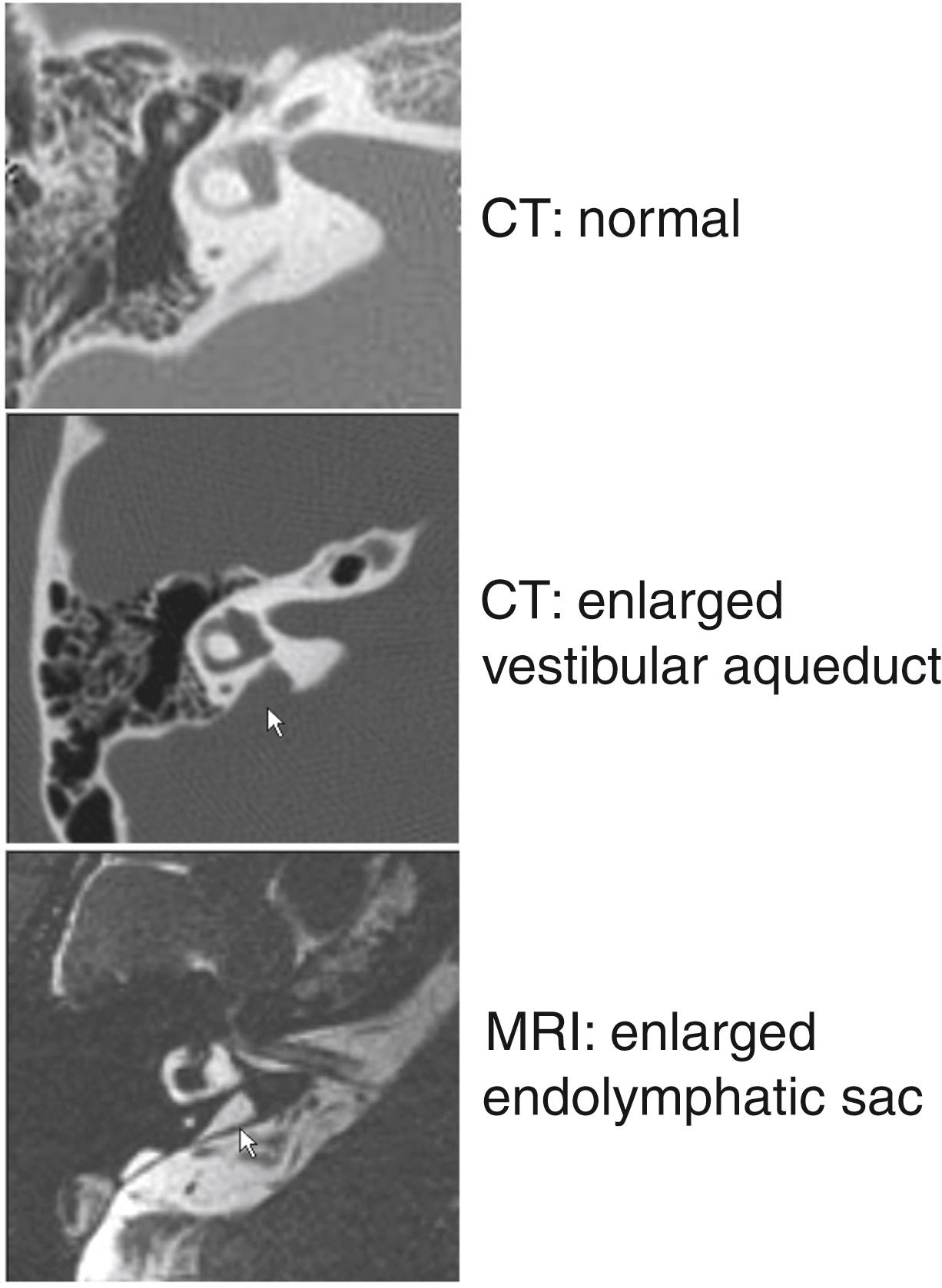 Fig. 14.1, Radiologic imaging of a right temporal bone with an enlarged vestibular aqueduct. Axial computed tomography (CT) scan of a normal vestibular aqueduct (top) . Axial CT scan (middle) and magnetic resonance image (MRI) (bottom) of the same ear with an enlarged vestibular aqueduct (arrow, middle). Arrows in the middle and bottom panels indicate the same location corresponding to the enlarged endolymphatic sac and duct represented by isodensity on CT and high signal intensity on MRI.