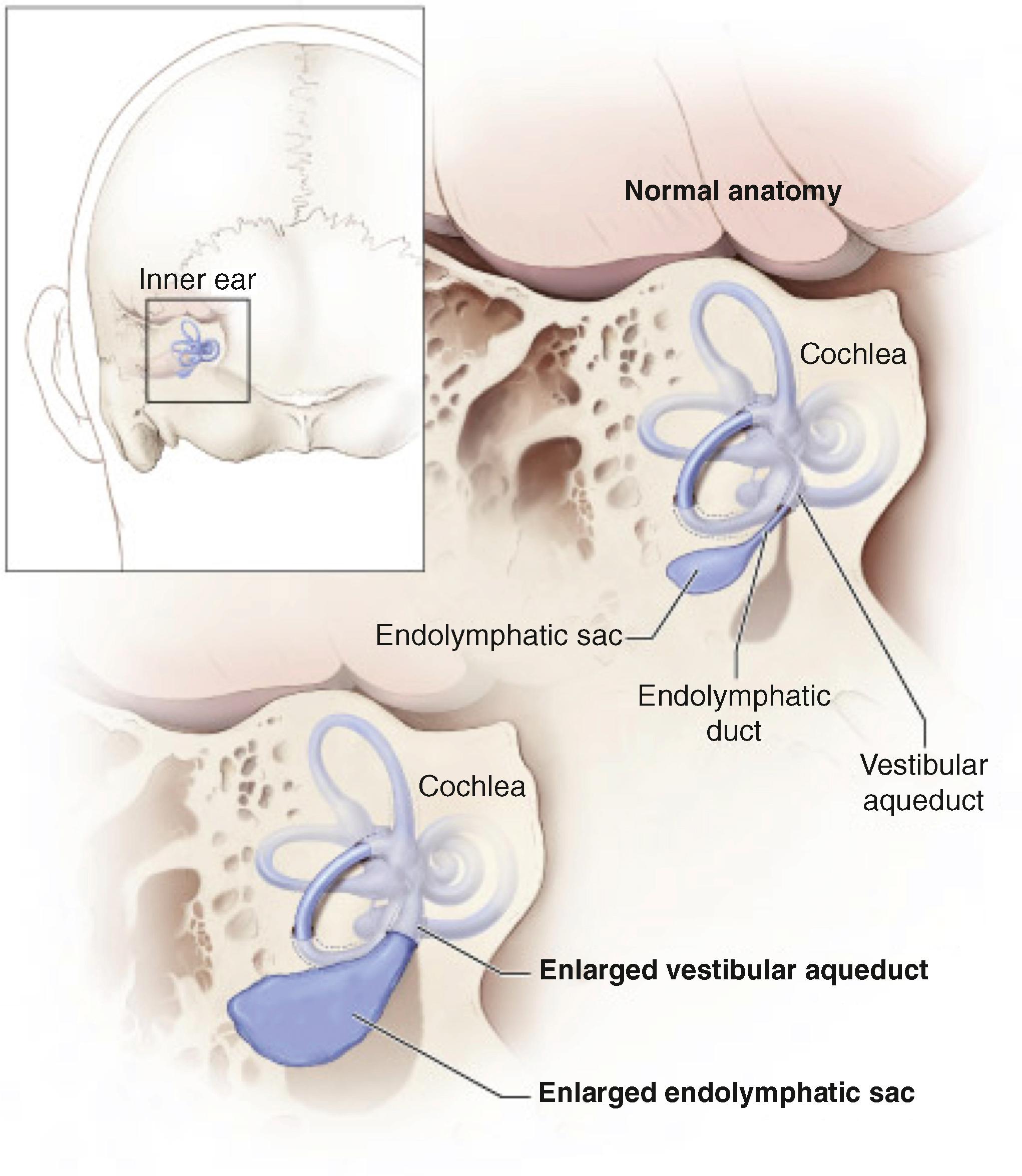 Fig. 14.2, Schematic illustration of an enlarged vestibular aqueduct and endolymphatic sac and duct.