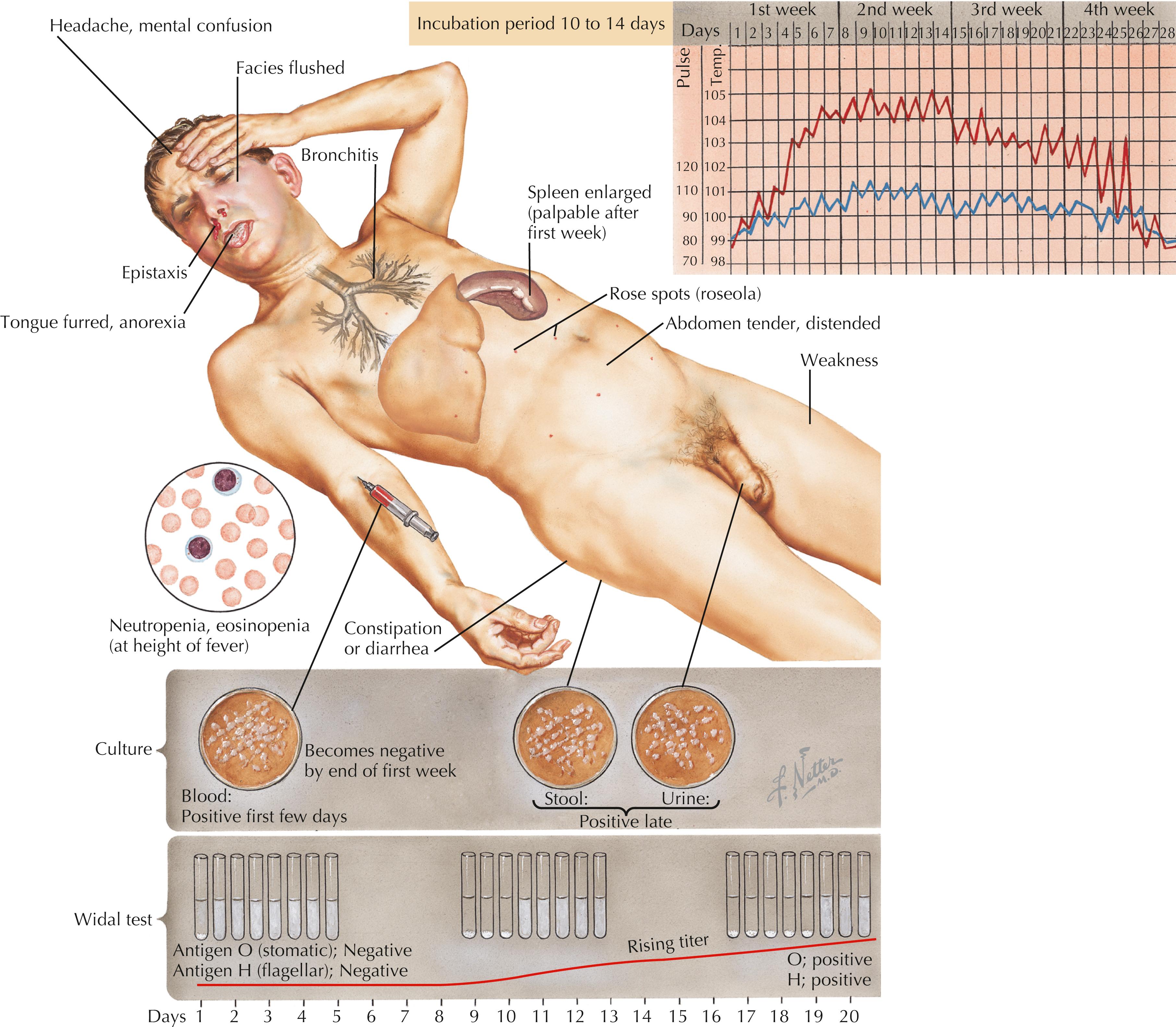 Fig. 67.2, Typhoid fever: clinical illness and diagnosis.