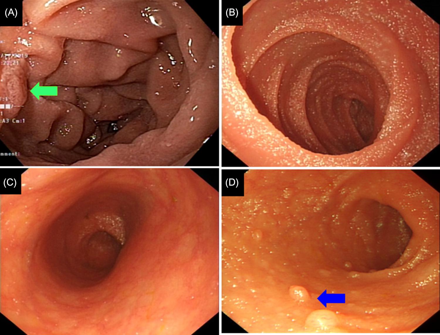 Figure 18.1, Normal small bowel: (A) normal duodenum and papilla ( green arrow ) with prominent Kerckring folds; (B) normal jejunum characterized by yellow-orange tubular shape, ringed by Kerckring folds and finger-like villi; (C) normal ileum with sparser Kerckring folds as well as sparser and shorter than the jejunum; and (D) lymphoid follicles sporadically distributed in the entire small bowel, have their highest concentrations in the terminal ileum ( blue arrow ).