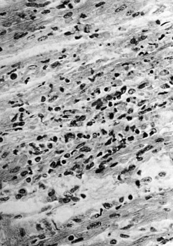 Figure 25-6, Coxsackievirus B4 myocarditis in a 9-day-old infant. Notice myocardial necrosis and mononuclear cellular infiltration.