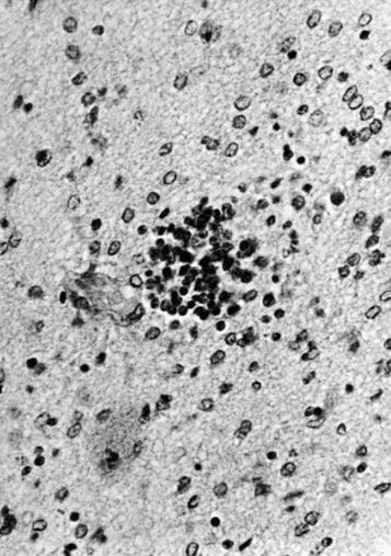 Figure 25-5, Coxsackievirus B4 encephalitis in a 9-day-old infant. Notice focal infiltrate of mononuclear and glial cells.