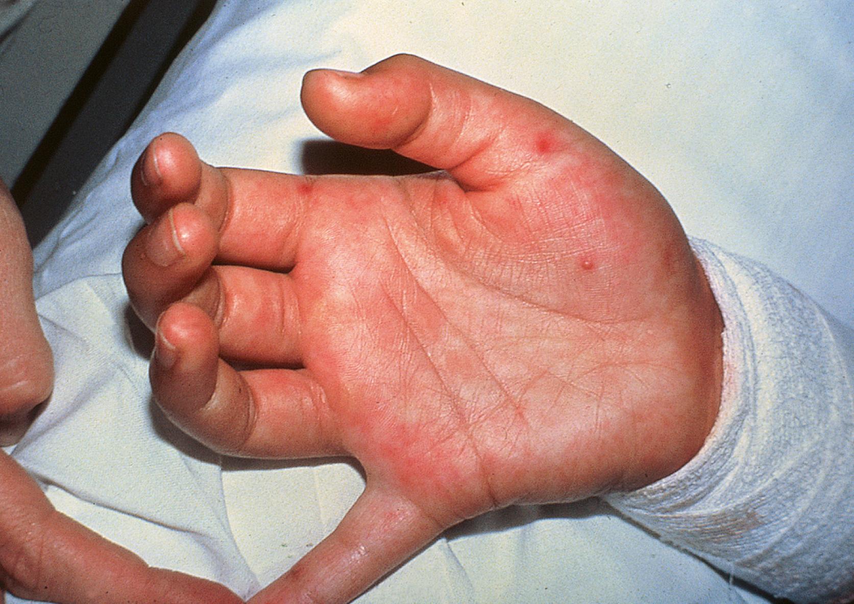FIGURE 236.1, Typical hand lesions of Coxsackie A virus in an infant with a febrile illness. No other exanthem was present.
