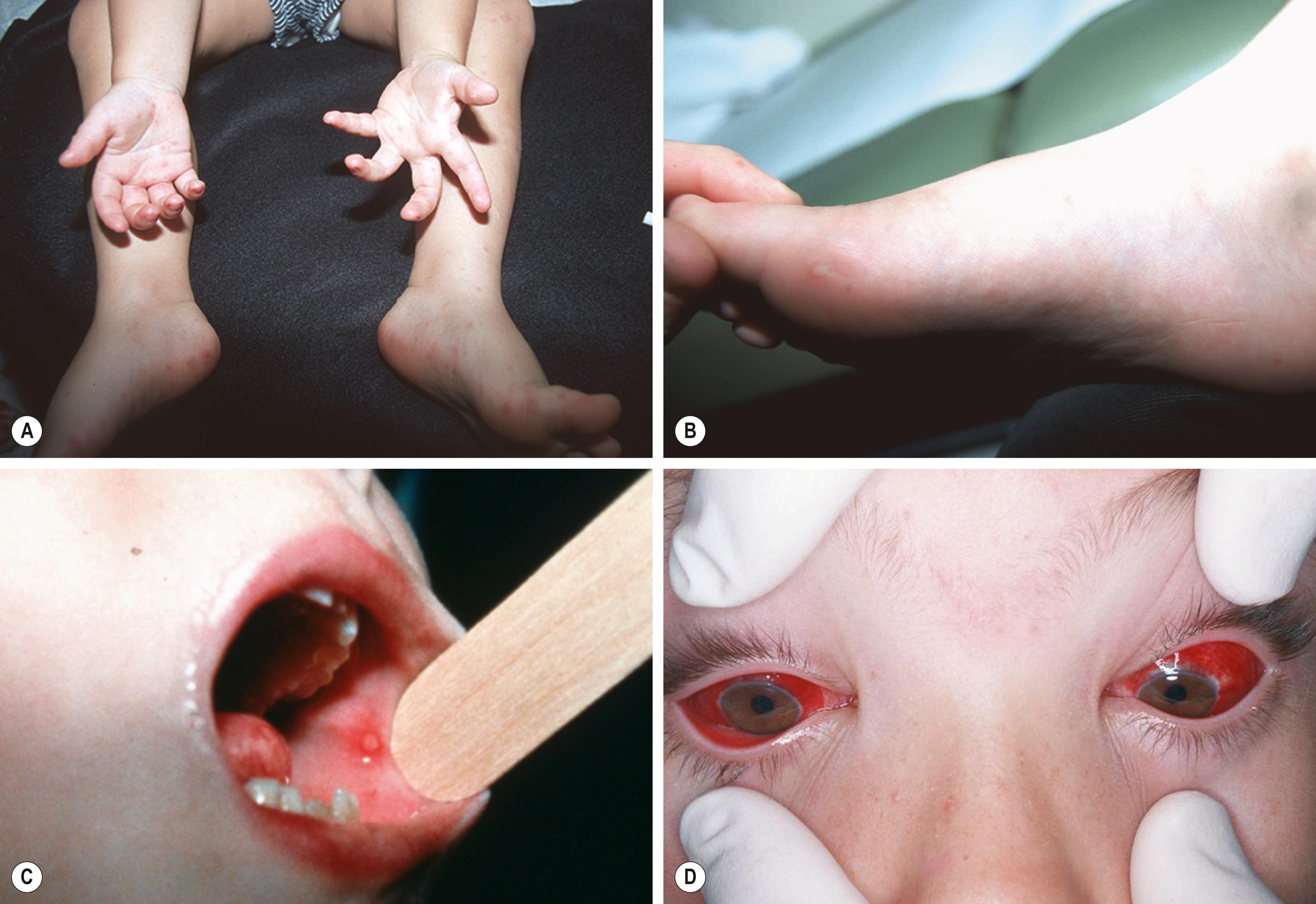 FIGURE 236.2, Characteristic findings of hand, foot, and mouth disease include (A, B) petechial, maculopapular, or vesicular lesions on hands and feet and (C) ulcerative lesions with erythema on the oral mucosa. (D) Acute hemorrhagic conjunctivitis with hemorrhage and edema of the conjunctivae.