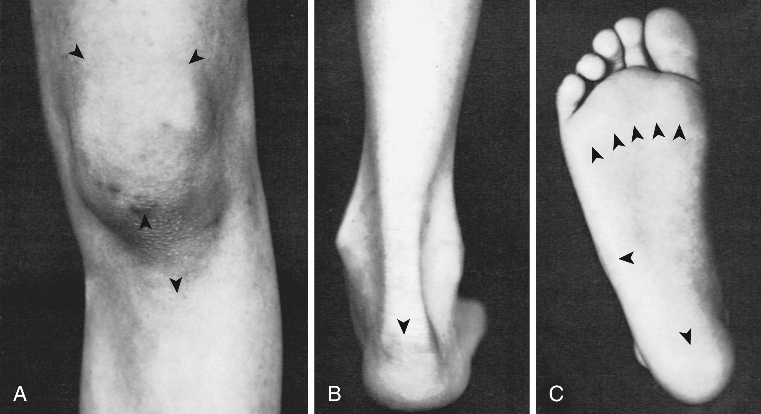 Fig. 20.2, A, Arrows indicate the most common sites of tenderness associated with enthesitis at the insertions of the quadriceps muscles into the patella and the attachments of the patellar ligament to the patella and tibial tuberosity. B, Arrow indicates the site of tenderness at the insertion of the Achilles tendon into the calcaneus. C, Arrows indicate the most common sites of tenderness associated with enthesitis at the insertion of the plantar fascia into the calcaneus, base of the fifth metatarsal, and heads of the first through fifth metatarsals. Swelling in this area is best visualized by having the child lie prone on the examining table with the feet over the edge.