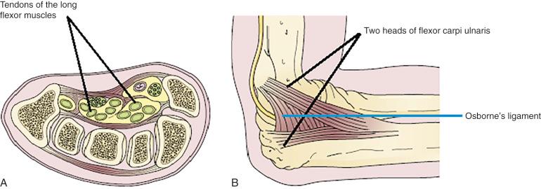 Figure 62.1, (A) Example of a fibro-osseous tunnel—the carpal tunnel at the wrist. The median nerve and the tendons of the long flexor muscles are the main contents of the tunnel. (B) Example of fibrotendinous arcade—the cubital canal at the elbow. The ulnar nerve enters the fibroaponeurotic arcade formed by the two heads of the flexor carpi ulnaris (Osborne ligament).