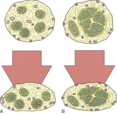 Figure 62.2, Nerves with a greater amount of epineurium (A) are less susceptible to compression than those with scanty epineurium (B)