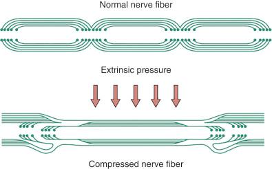 Figure 62.3, Telescoping of myelin sheath with acute and severe nerve compression.