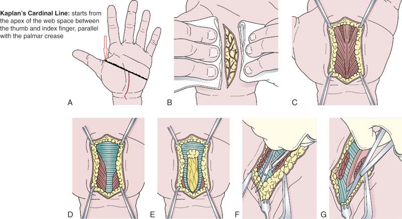 Figure 62.4, (A) The skin incision extends from the wrist crease to intersect the Kaplan's Cardinal Line in the interthenar space with the fully extended thumb (the red line). An optional extension may be carried out in the distal forearm (curvilinear interrupted line) to facilitate exposure of the proximal part of the transverse carpal ligament and the distal part of the deep fascia of the forearm. Note that the main skin incision is not in the palmar skin crease but just medial to it. (B) Protrusion of exuberant palmar subcutaneous fat after the skin incision is made. (C) Exposure of the palmar aponeurosis. (D) Exposure of the transverse carpal ligament after midline section and retraction of the palmar aponeurosis. The distal margin of the transverse carpal ligament can faintly be seen blending with the deep fascia of the palm. The proximal part of the transverse carpal ligament is covered by the hypothenar and thenar muscles. In many instances (not shown in this illustration) they may meet and interdigitate in the midline, blocking the transverse carpal ligament from view. (E) About 80% of the transverse carpal ligament has been divided, exposing the median nerve. Note the constant fat globule superficial to the median nerve at the distal end of the exposure. (F) Proximal skin is undermined with retraction to facilitate exposure of the proximal part of the transverse carpal ligament. (G) Section of the most proximal part of the transverse carpal ligament and the distal deep fascia of the forearm.