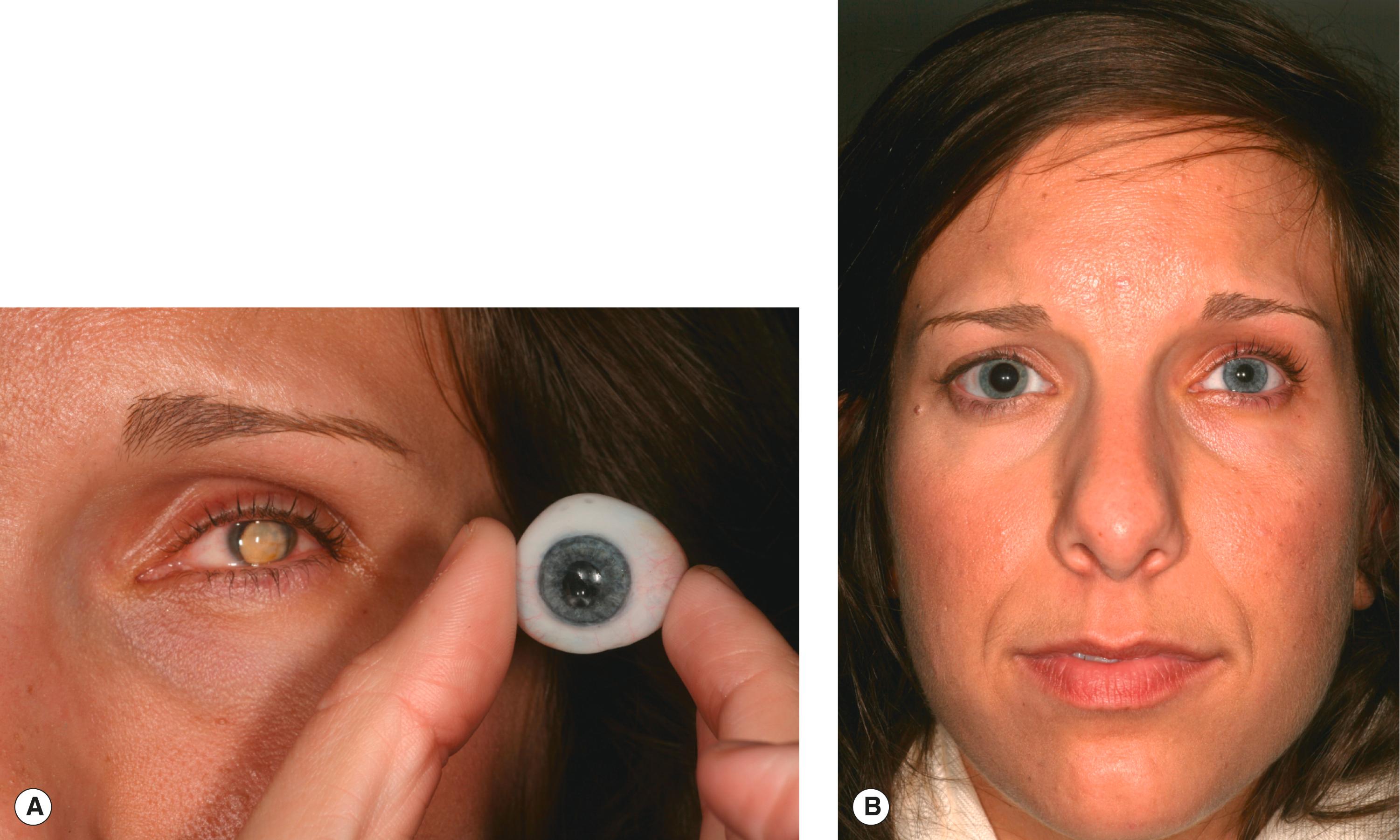 Figure 16.1, Scleral shell. ( A ) Painless small eye is a good choice for a scleral shell. ( B ) Comfortable scleral shell in place with natural appearance and reasonable symmetry.