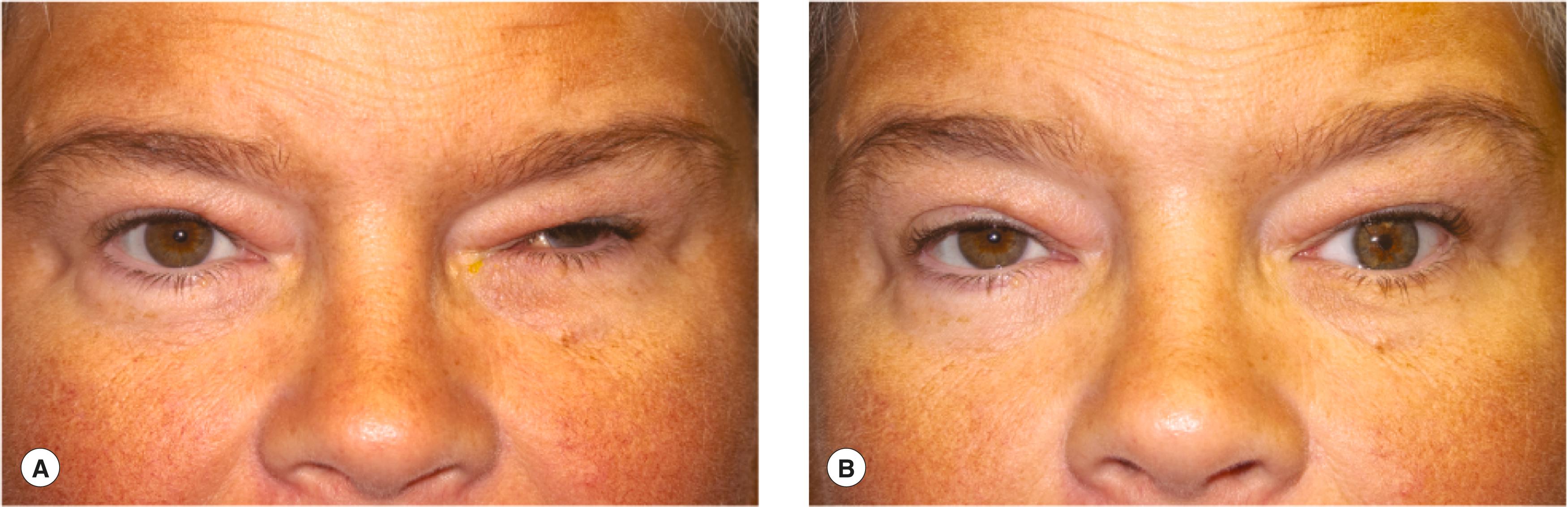 Figure 16.2, Scleral shell. ( A ) This patient has comfortable small blind eye that doesn't look good. ( B ) The patient is comfortably wearing the custom scleral shell. A nearly symmetric appearance.