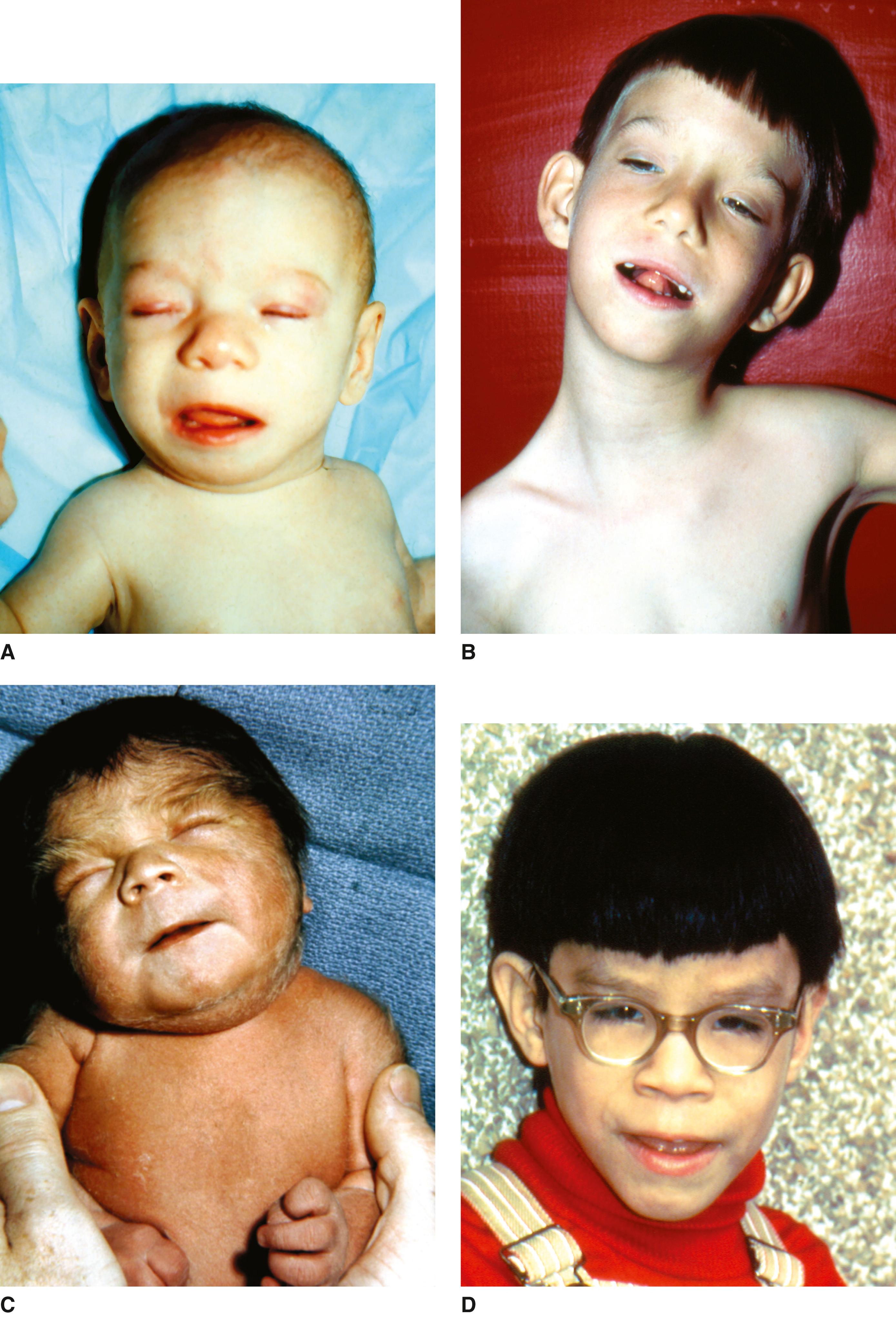 FIGURE 1, Fetal alcohol syndrome.