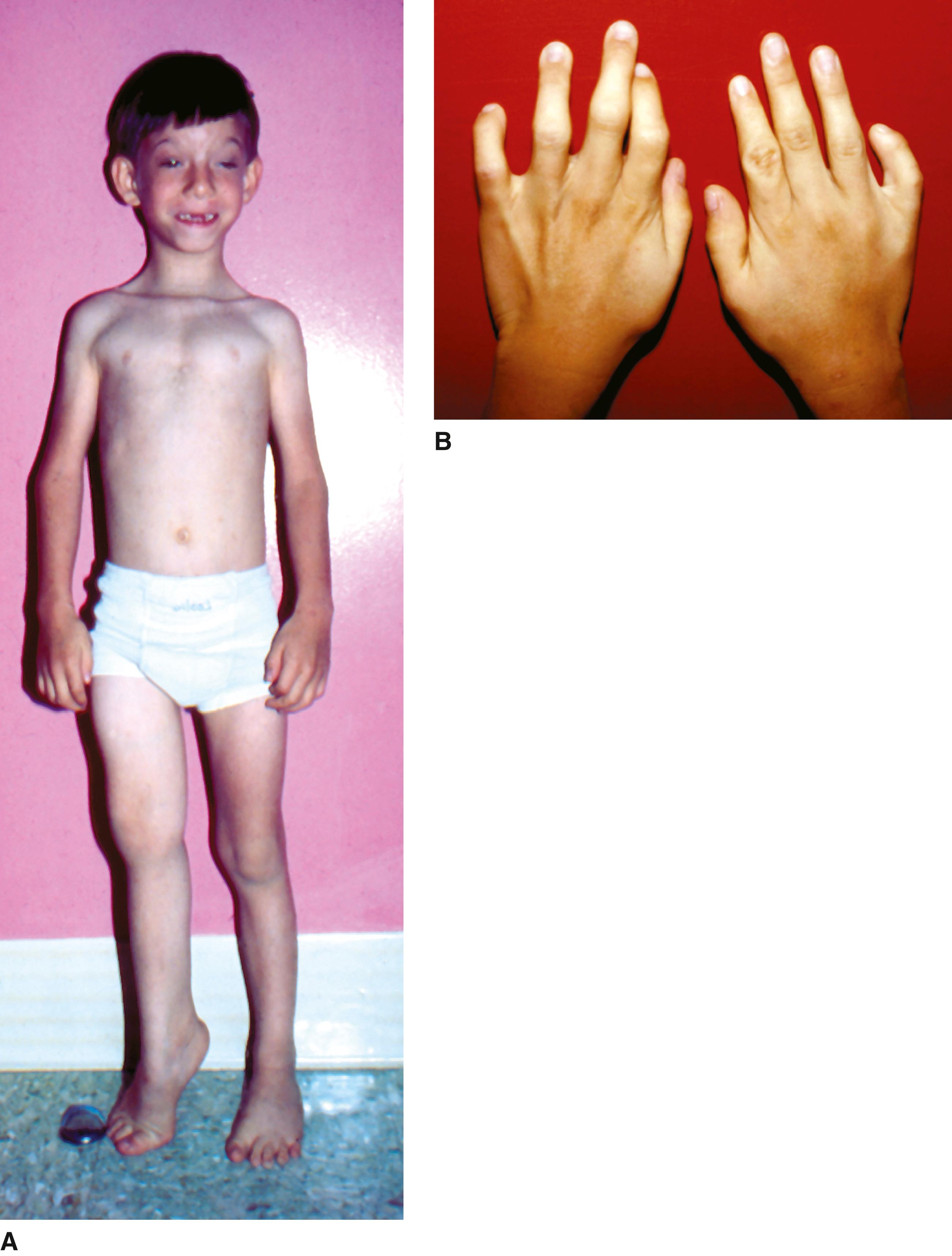 FIGURE 3, A , Short right leg secondary to congenital hip dislocation. B, Camptodactyly.