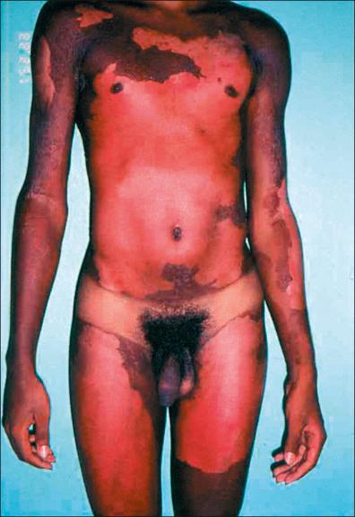 Figure 36-2, Severe case of phototoxic dermatitis due to fig leaves ( Ficus carica).