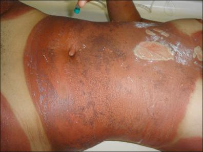 Figure 36-3, Second-degree burn after fig leaves bath for tanning.