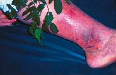 Figure 36-5, Contact dermatitis on lower limb due to aroeira. 15