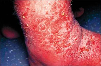 Figure 36-7, Chronic case of contact dermatitis due to aroeira, manifest as lichenified lesions and scaling dermatitis.