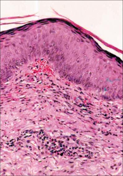 Figure 36-8, Contact dermatitis due to plants with a mild acanthosis and upper dermal perivascular infiltrate rich in both eosinophilis and lymphocytes.