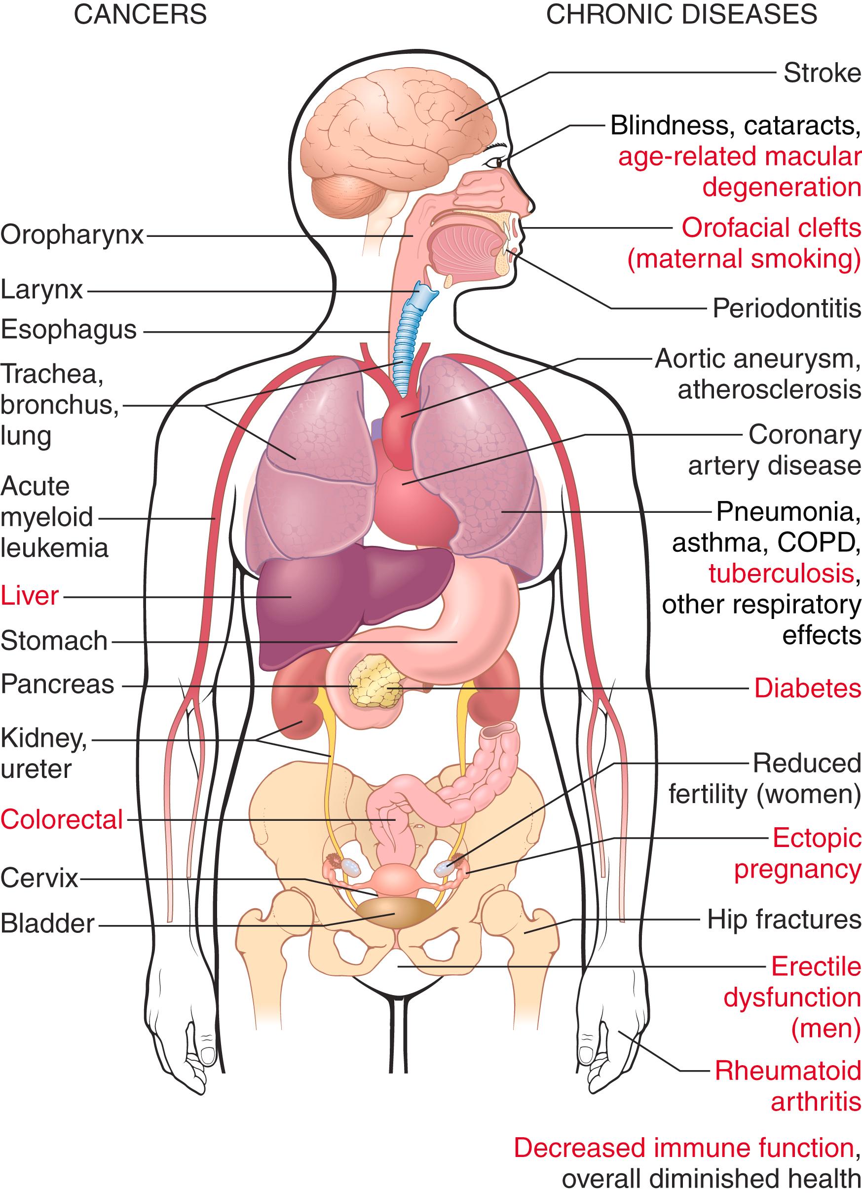 FIG. 7.9, Health consequences causally linked to smoking. Items in red were added relatively recently to the list of ill effects of smoking. COPD, Chronic obstructive pulmonary disease. (US Department of Health and Human Services: The Health Consequences of Smoking—50 Years of Progress: A Report of the Surgeon General , Atlanta, 2016, US Department of Health and Human Services, Centers for Disease Control and Prevention, National Center for Chronic Disease Prevention and Health Promotion, Office on Smoking and Health.)