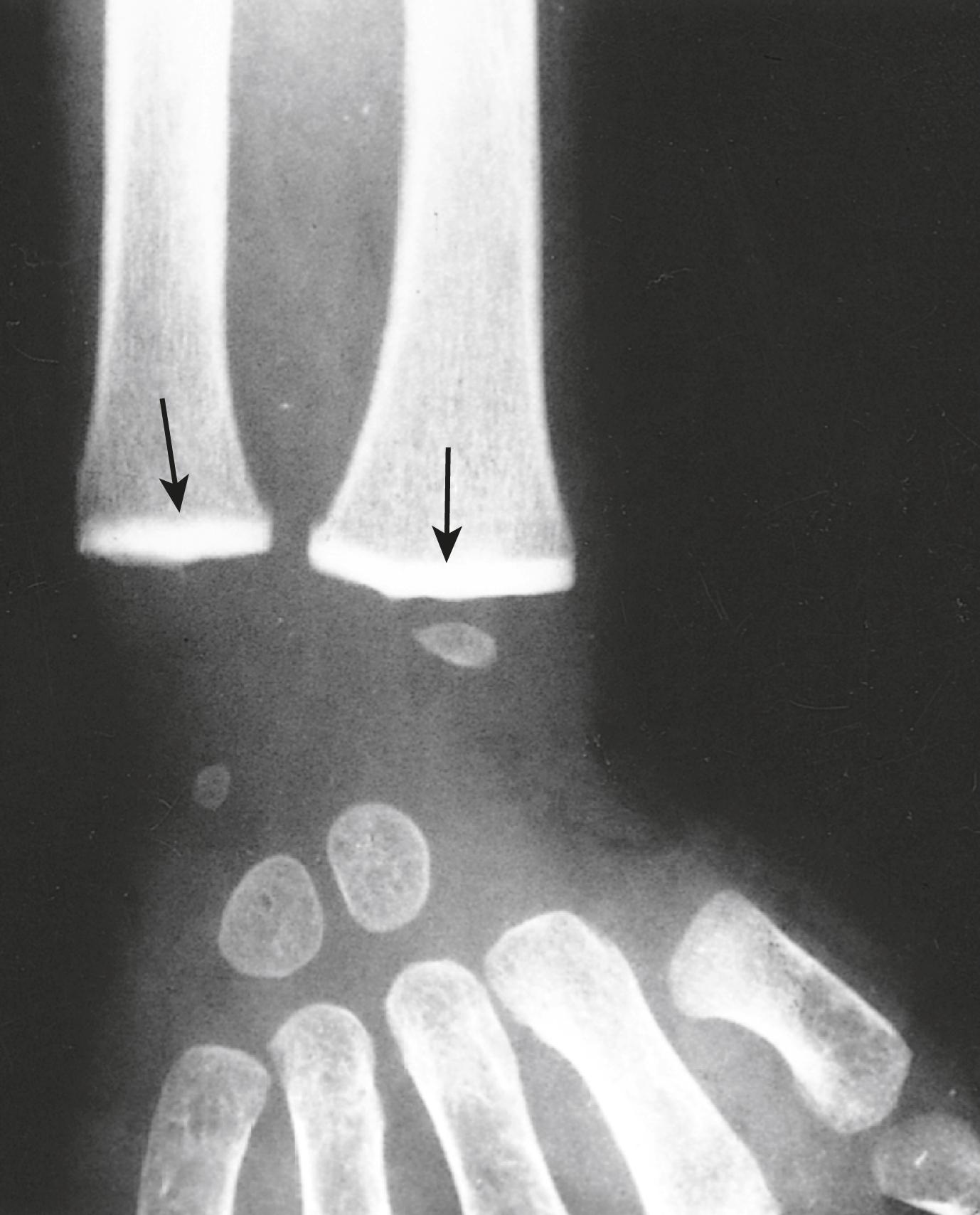 FIG. 7.6, Lead poisoning. Impaired remodeling of calcified cartilage in the physes (arrows) of the wrist has caused a marked increase in their radiodensity, so that they are as radiopaque as the cortical bone. (Courtesy of Dr. GW Dietz, Department of Radiology, University of Texas Southwestern Medical School, Dallas, Texas.)