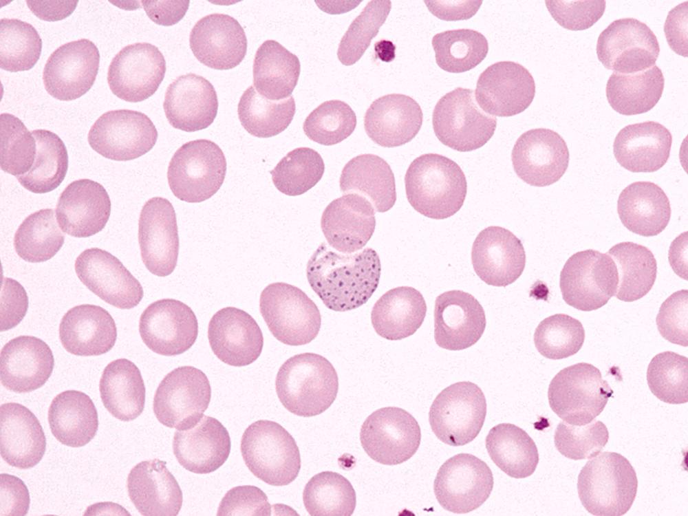 FIG. 7.7, Basophilic stippling in lead poisoning. Coarse stippling in the red cell in the middle of the field is common in lead poisoning and is also seen in other anemias caused by impaired hemoglobin synthesis (e.g., megaloblastic anemia).