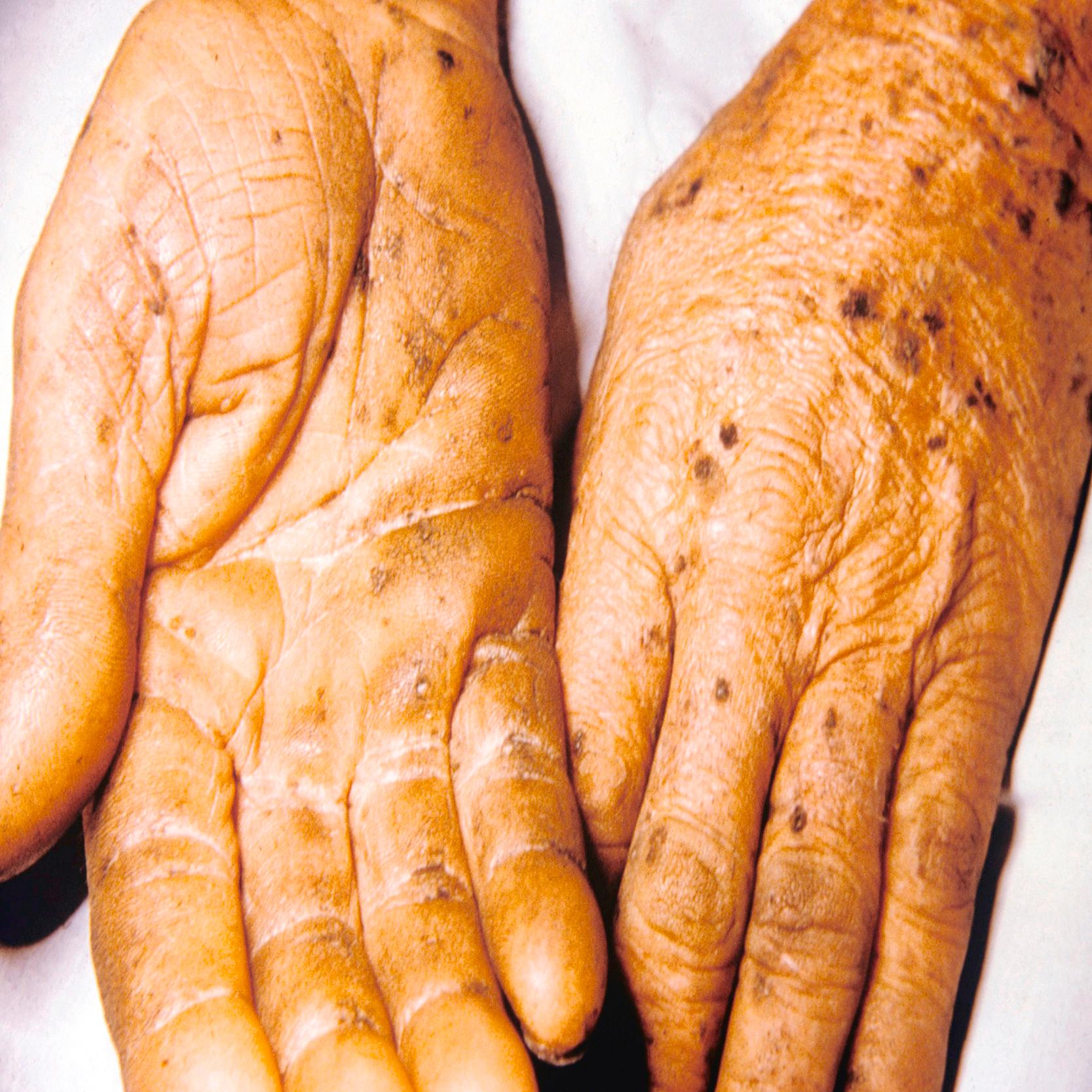 eFIG. 7.2, Arsenical keratoses: Signs of arsenic poisoning demonstrating hyperpigmented keratotic papules on the palms and dorsal hands.