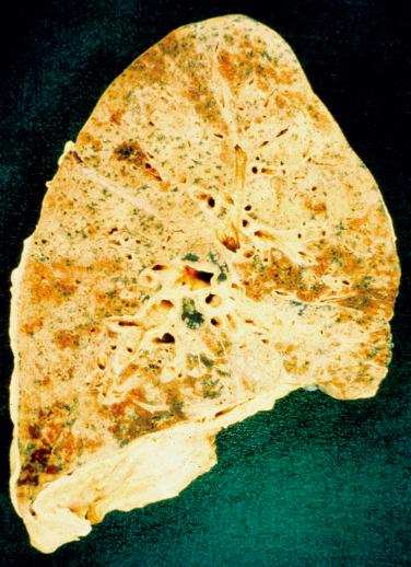 FIG. 18.1, Asbestosis. The lung shows fibrotic changes and fine honeycombing that is most marked in the lower zones. Mild pleural fibrosis is seen.