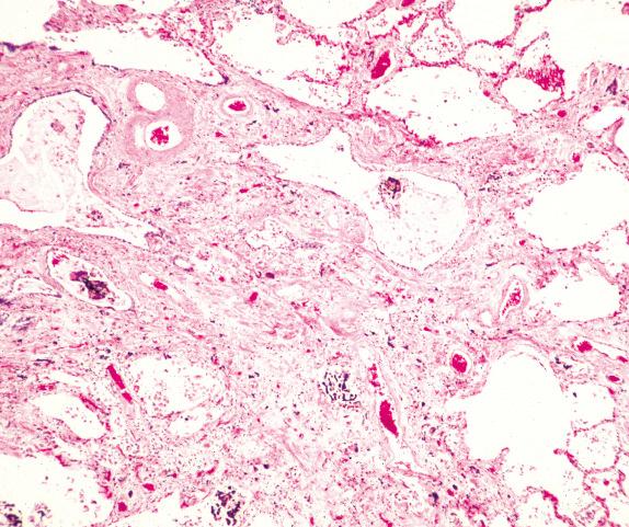 FIG. 18.3, Asbestosis. Severe interstitial fibrosis with disorganization of lung architecture is evident, and numerous asbestos bodies are seen. Ferruginous fragments (also seen) should not be assumed to be asbestos bodies.