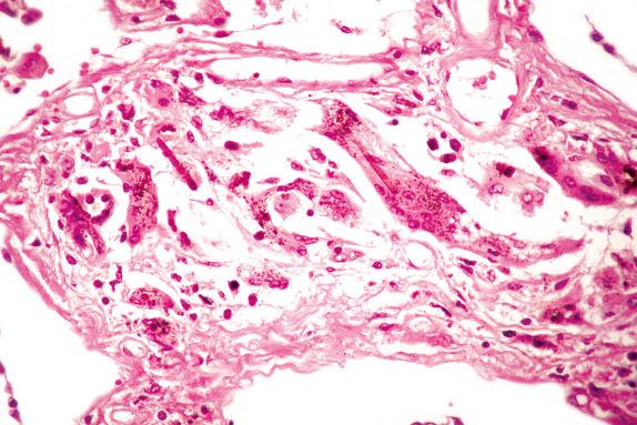 FIG. 18.4, Asbestosis. Several asbestos bodies are visible, indicative of heavy occupational exposure.