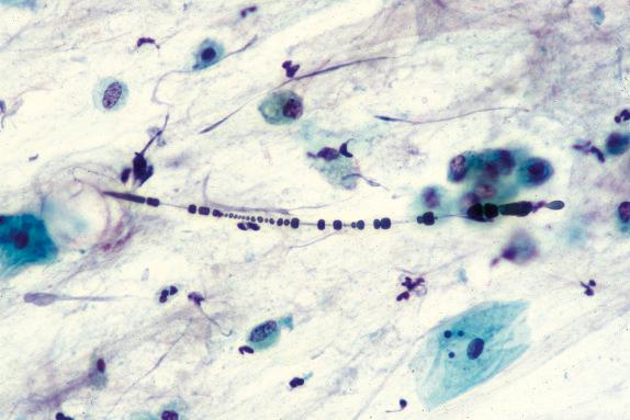 FIG. 18.5, Asbestosis. An asbestos body displays a clear fibrous core coated by iron-containing material.