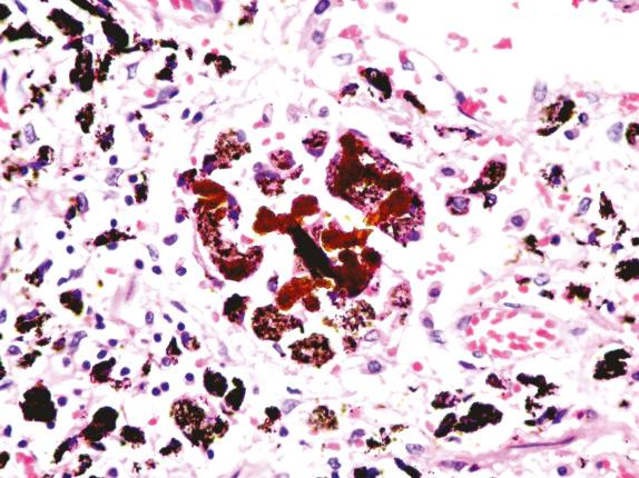 FIG. 18.6, Coal workers’ pneumoconiosis. “Coal bodies” consist of black and brown irregular fragments of material.