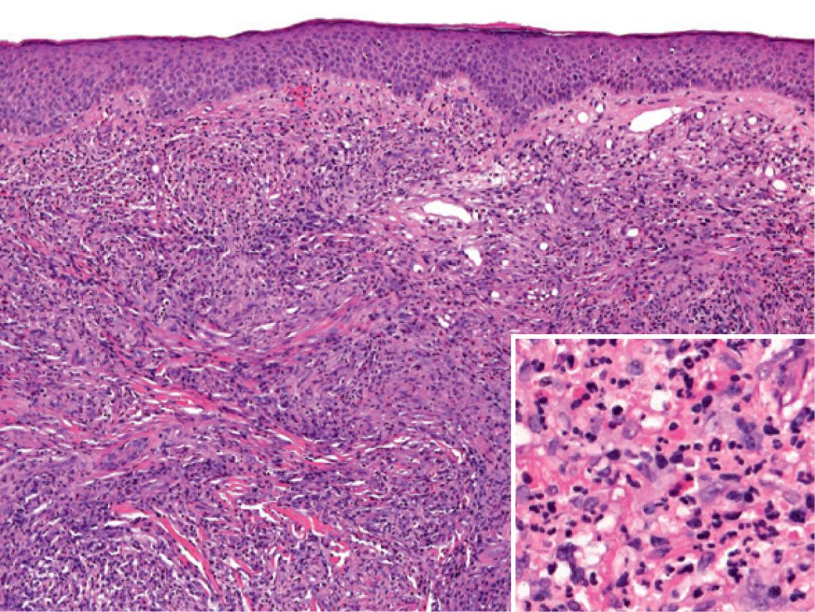 Fig. 25.4, Granuloma faciale.