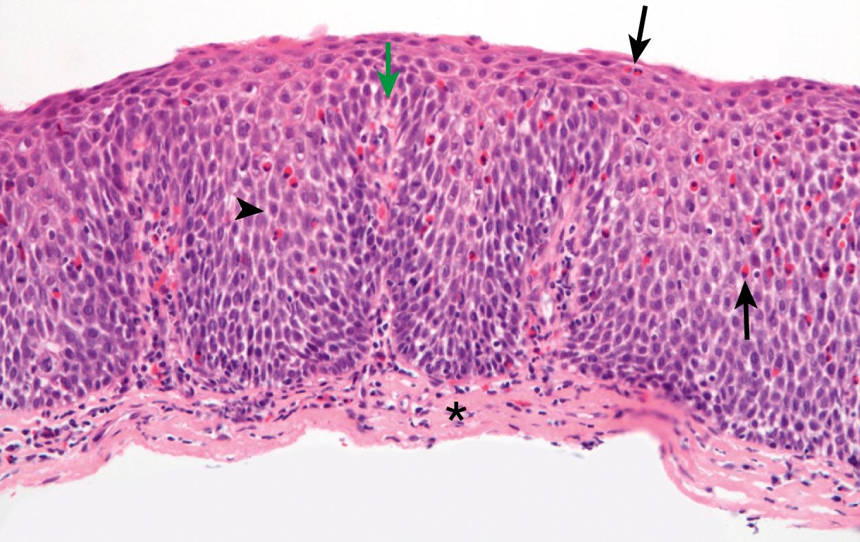 Fig. 30.2, Hematoxylin and eosin staining of esophagus from a patient with EoE. Arrows point to eosinophils, including at the surface, arrowhead points to dilated intercellular spaces, asterisk marks lamina propria showing inflammation and fibrosis, and the green arrow points to elongated papillae. There is also marked basal layer hyperplasia with the basal layer reaching almost to the surface.