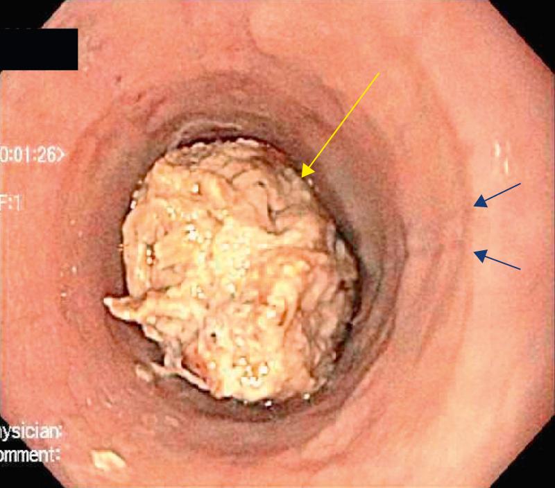 Fig. 350.1, Endoscopic visualization of esophageal food impaction (yellow arrow) and mucosal rings (blue arrows) .