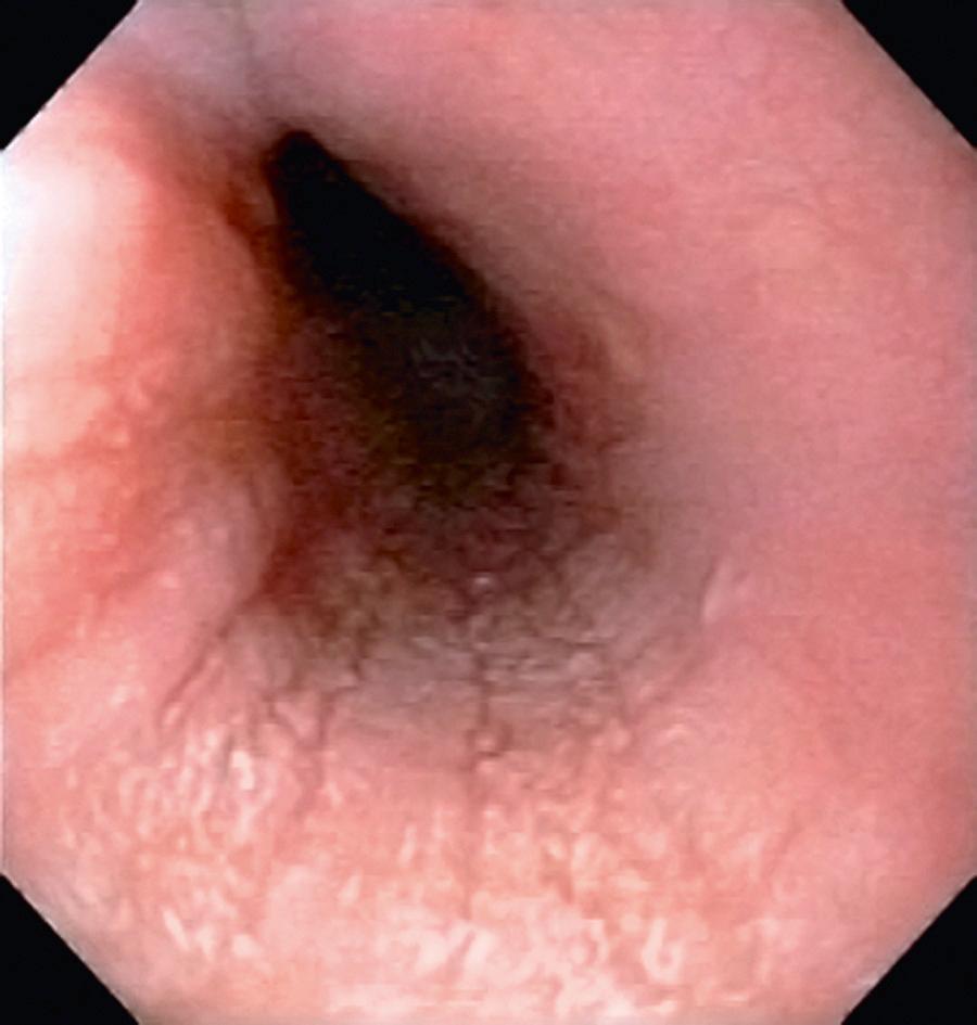 Fig. 350.2, Endoscopic image of eosinophilic esophagitis with characteristic mucosal appearance of furrowing and white specks.