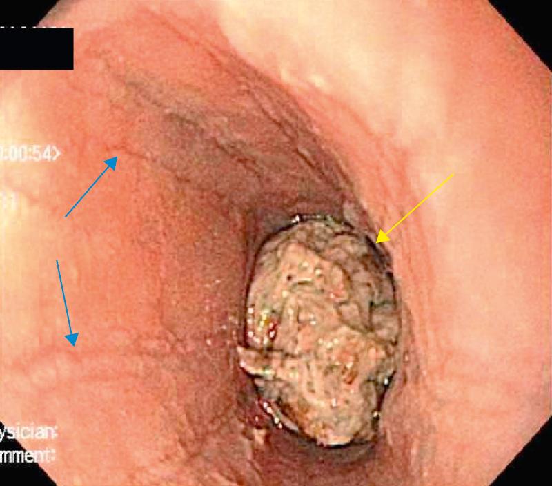 Fig. 350.3, Endoscopy photograph showing mucosal furrowing (blue arrows) characteristic of Eosinophilic esophagitis in a patient with food impaction (yellow arrow) .